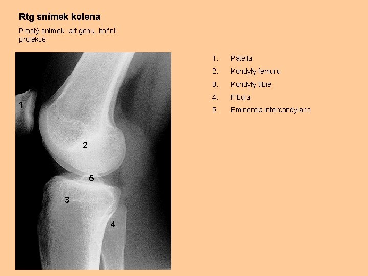 Rtg snímek kolena Prostý snímek art. genu, boční projekce 1 2 5 3 4