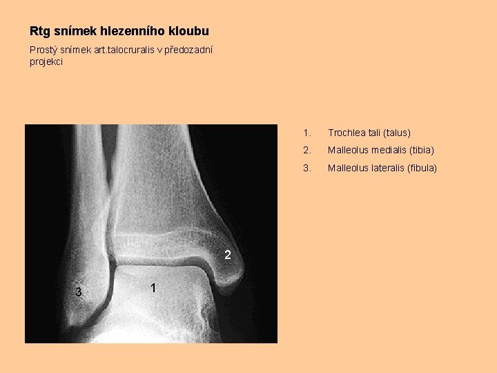 Rtg snímek hlezenního kloubu Prostý snímek art. talocruralis v předozadní projekci 2 3 1