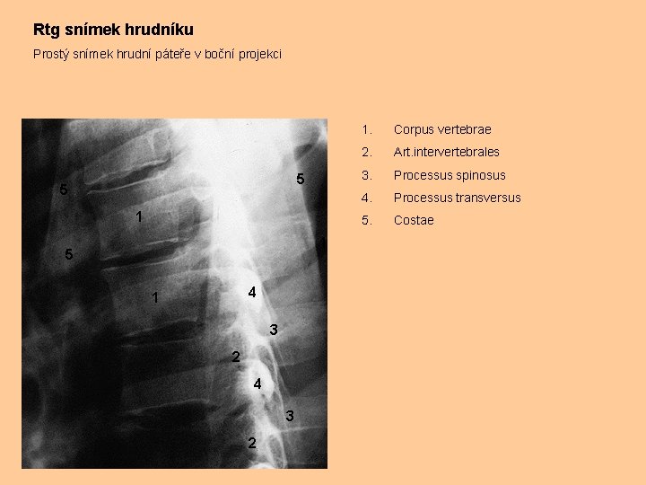 Rtg snímek hrudníku Prostý snímek hrudní páteře v boční projekci 5 5 1 1