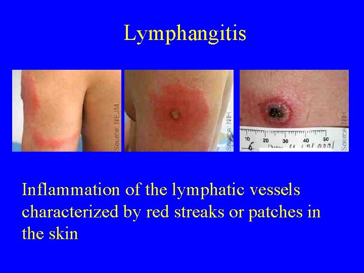 Lymphangitis Inflammation of the lymphatic vessels characterized by red streaks or patches in the