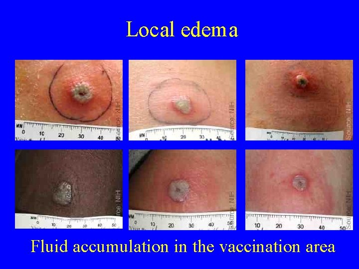 Local edema Fluid accumulation in the vaccination area 