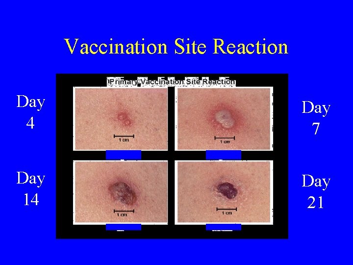 Vaccination Site Reaction Day 4 Day 7 Day 14 Day 21 