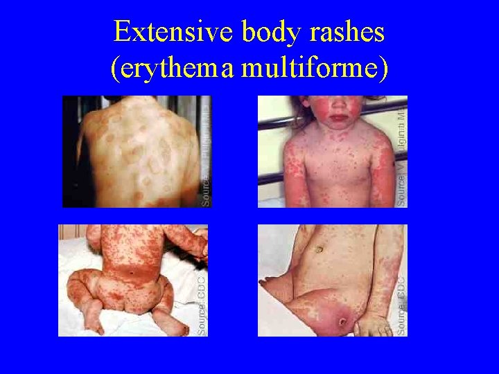 Extensive body rashes (erythema multiforme) 