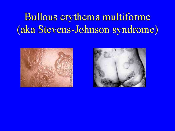 Bullous erythema multiforme (aka Stevens-Johnson syndrome) 