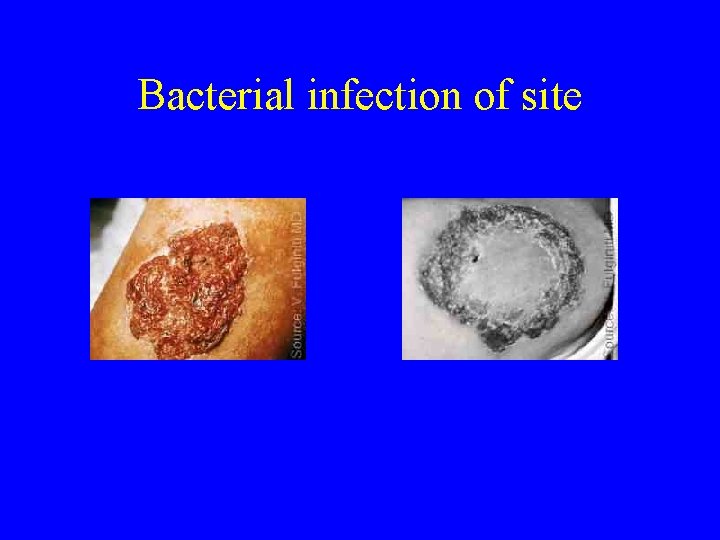 Bacterial infection of site 