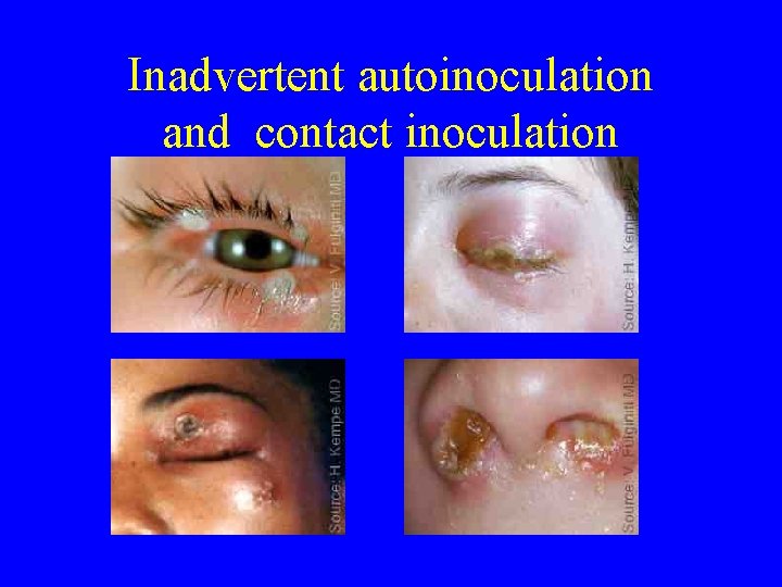 Inadvertent autoinoculation and contact inoculation 