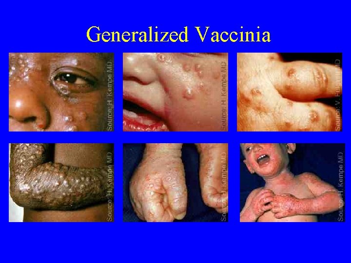 Generalized Vaccinia 