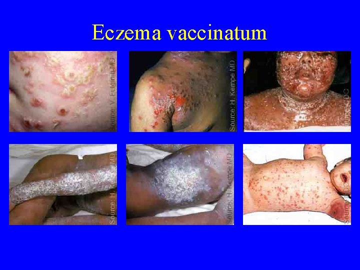 Eczema vaccinatum 