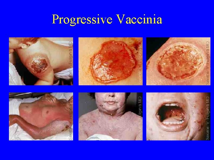 Progressive Vaccinia 