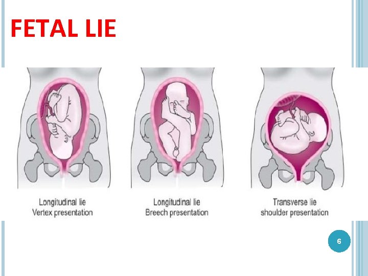 FETAL LIE 6 