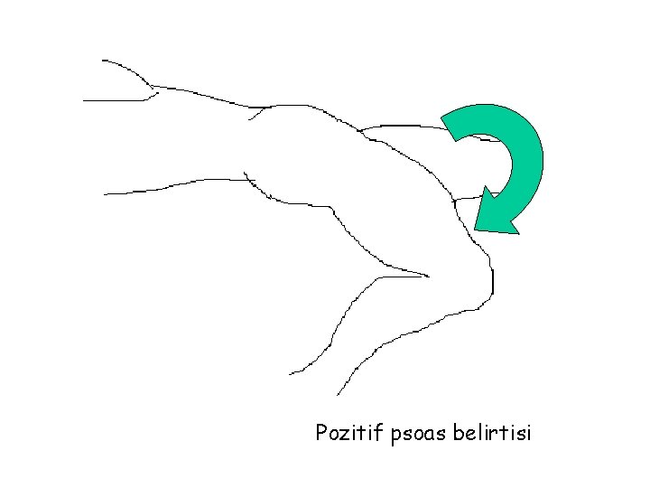 Pozitif psoas belirtisi 