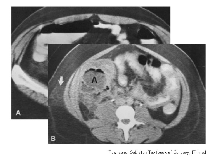 Townsend: Sabiston Textbook of Surgery, 17 th ed 