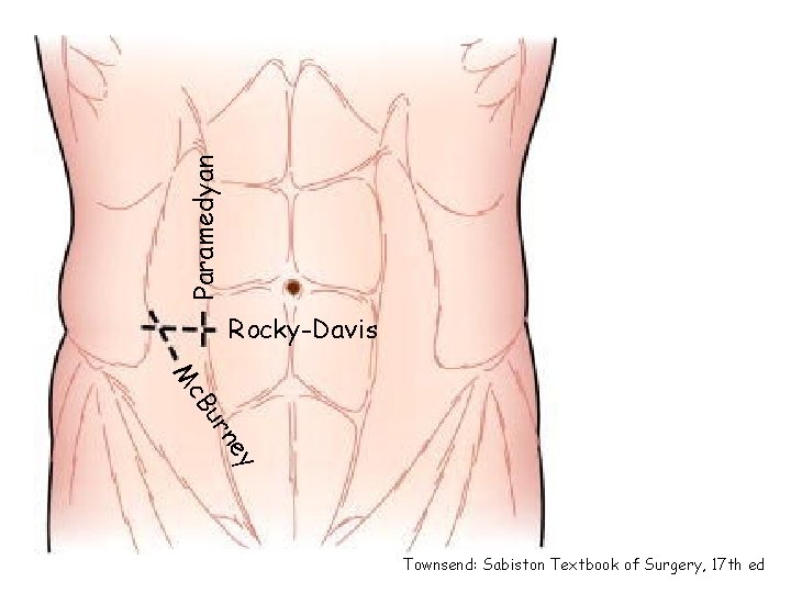 Paramedyan Rocky-Davis y ne ur c. B M Townsend: Sabiston Textbook of Surgery, 17