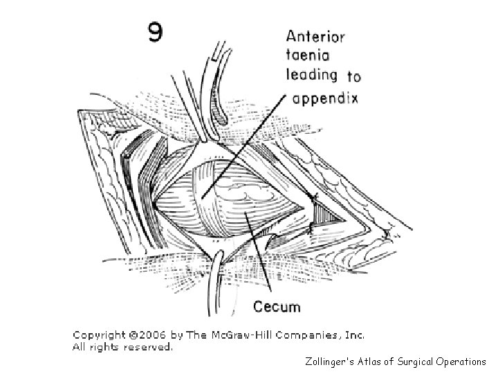 Zollinger's Atlas of Surgical Operations 