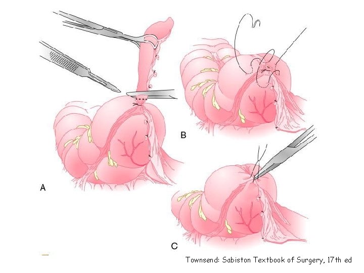 Townsend: Sabiston Textbook of Surgery, 17 th ed 