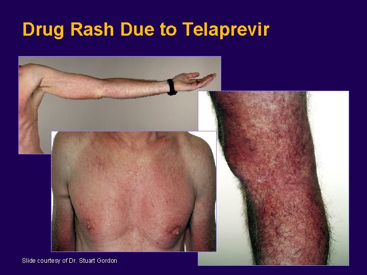 Drug Rash Due to Telaprevir Slide courtesy of Dr. Stuart Gordon 