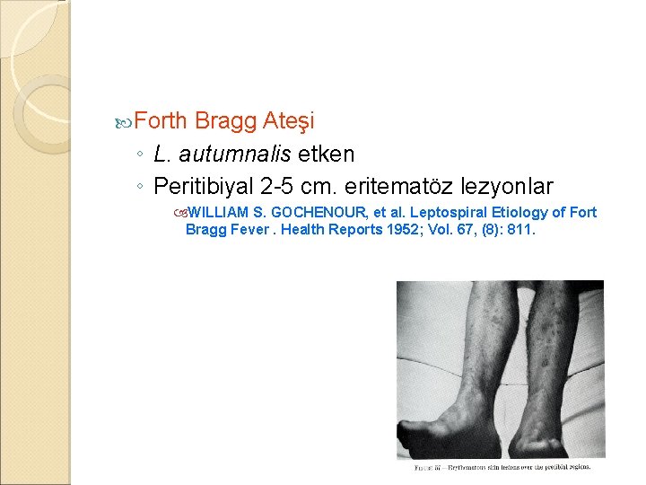  Forth Bragg Ateşi ◦ L. autumnalis etken ◦ Peritibiyal 2 -5 cm. eritematöz