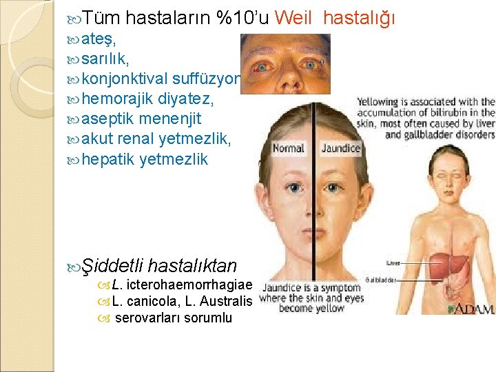  Tüm hastaların %10’u ateş, sarılık, konjonktival suffüzyon, hemorajik diyatez, aseptik menenjit akut renal