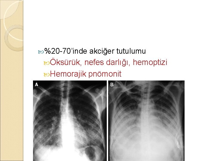  %20 -70’inde akciğer tutulumu Öksürük, nefes darlığı, hemoptizi Hemorajik pnömonit -ARDS’ye kadar 