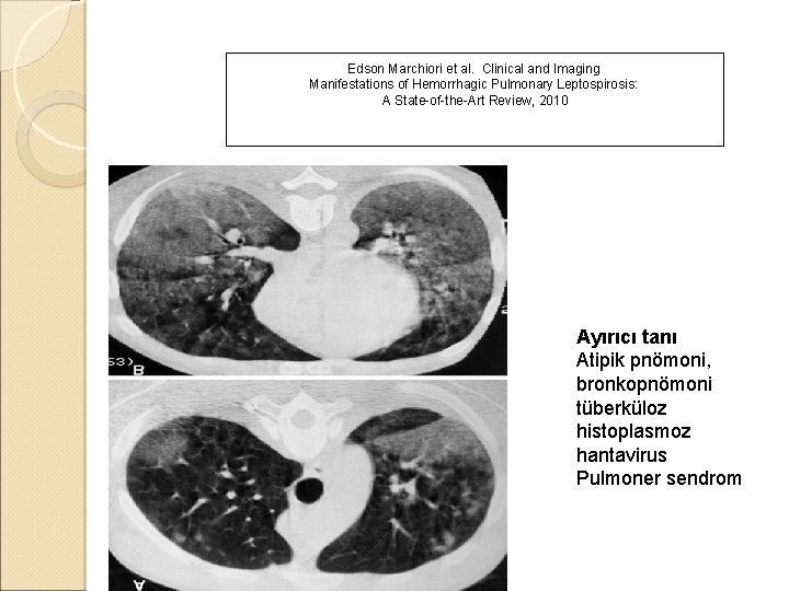 Edson Marchiori et al. Clinical and Imaging Manifestations of Hemorrhagic Pulmonary Leptospirosis: A State-of-the-Art