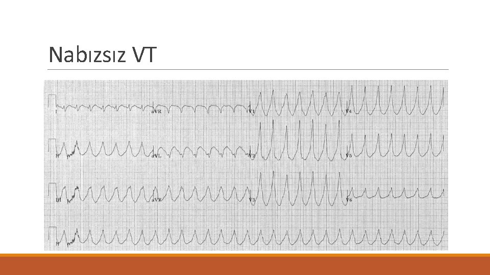 Nabızsız VT 