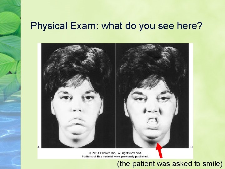 Physical Exam: what do you see here? (the patient was asked to smile) 