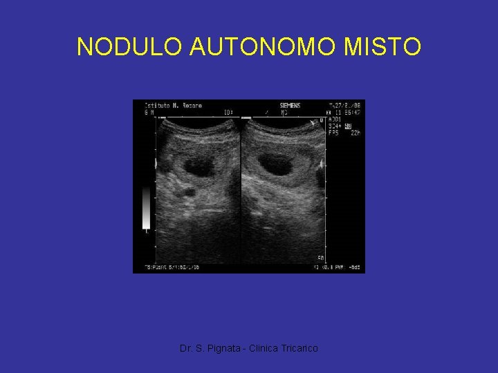 NODULO AUTONOMO MISTO Dr. S. Pignata - Clinica Tricarico 