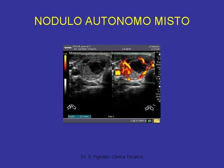 NODULO AUTONOMO MISTO Dr. S. Pignata - Clinica Tricarico 