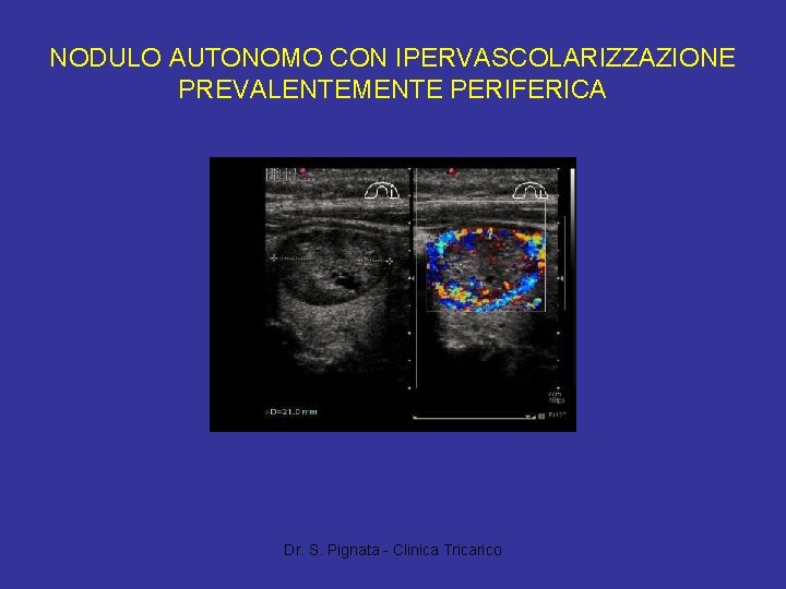 NODULO AUTONOMO CON IPERVASCOLARIZZAZIONE PREVALENTEMENTE PERIFERICA Dr. S. Pignata - Clinica Tricarico 