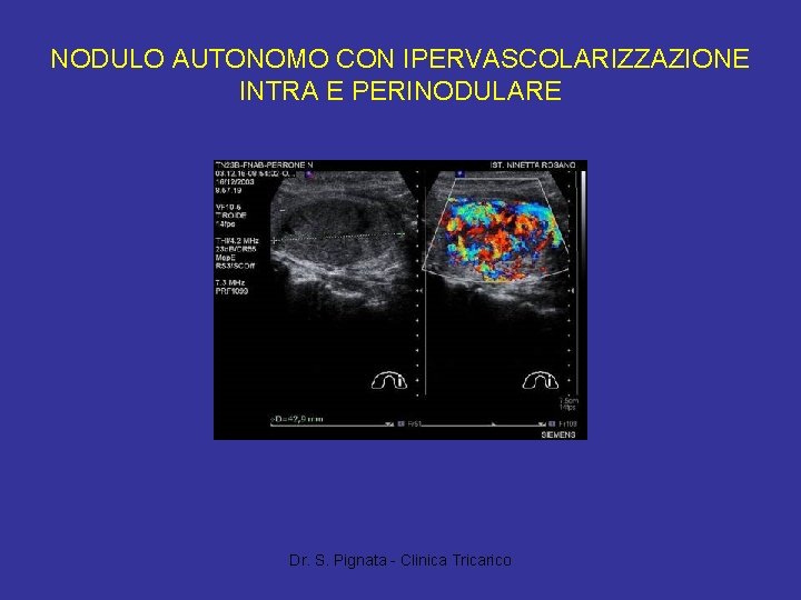 NODULO AUTONOMO CON IPERVASCOLARIZZAZIONE INTRA E PERINODULARE Dr. S. Pignata - Clinica Tricarico 