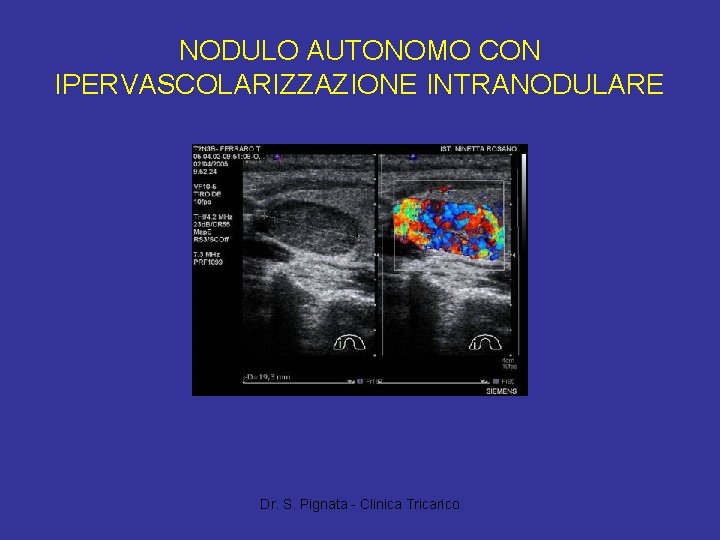 NODULO AUTONOMO CON IPERVASCOLARIZZAZIONE INTRANODULARE Dr. S. Pignata - Clinica Tricarico 