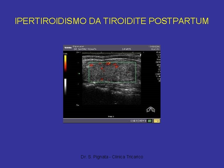 IPERTIROIDISMO DA TIROIDITE POSTPARTUM Dr. S. Pignata - Clinica Tricarico 