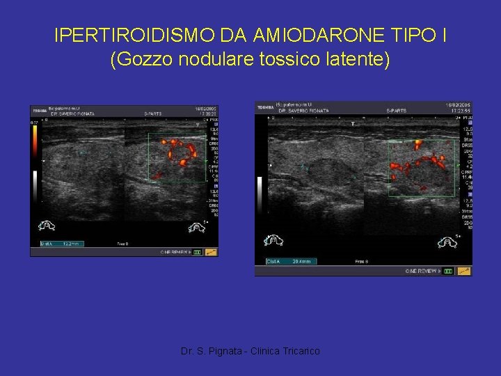 IPERTIROIDISMO DA AMIODARONE TIPO I (Gozzo nodulare tossico latente) Dr. S. Pignata - Clinica