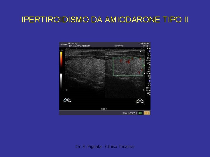 IPERTIROIDISMO DA AMIODARONE TIPO II Dr. S. Pignata - Clinica Tricarico 