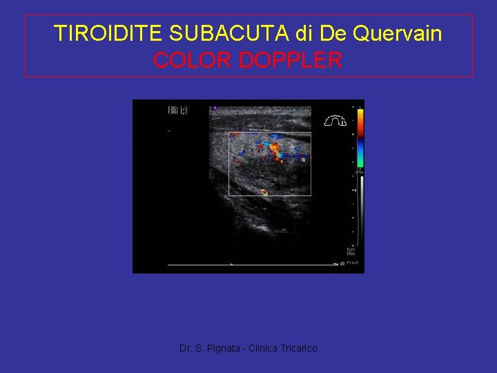 TIROIDITE SUBACUTA di De Quervain COLOR DOPPLER Dr. S. Pignata - Clinica Tricarico 