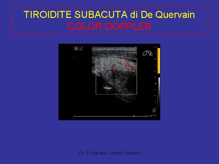 TIROIDITE SUBACUTA di De Quervain COLOR DOPPLER Dr. S. Pignata - Clinica Tricarico 