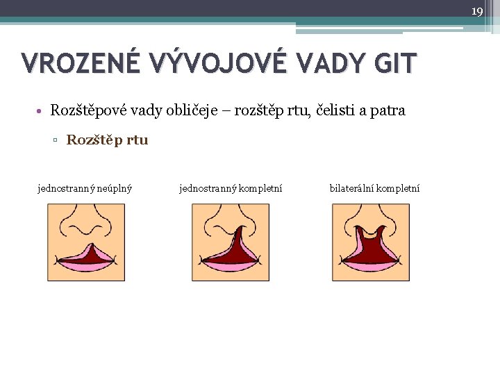 19 VROZENÉ VÝVOJOVÉ VADY GIT • Rozštěpové vady obličeje – rozštěp rtu, čelisti a