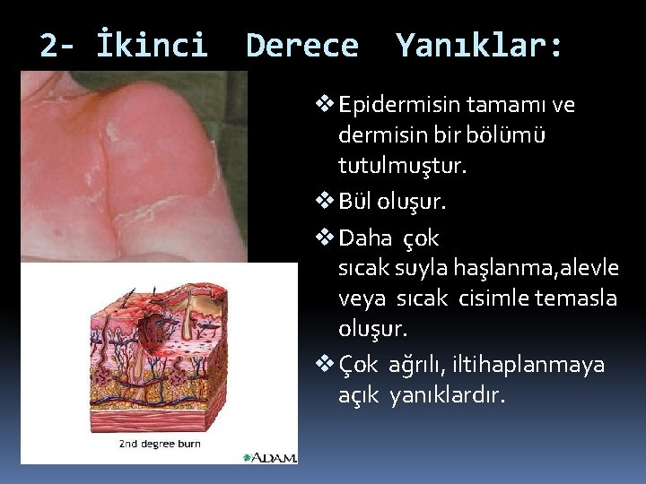 2 - İkinci Derece Yanıklar: v Epidermisin tamamı ve dermisin bir bölümü tutulmuştur. v 2 - İkinci Derece Yanıklar: v Epidermisin tamamı ve dermisin bir bölümü tutulmuştur. v