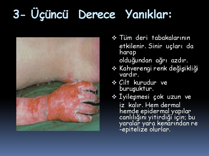 3 - Üçüncü Derece Yanıklar: v Tüm deri tabakalarının etkilenir. Sinir uçları da harap 3 - Üçüncü Derece Yanıklar: v Tüm deri tabakalarının etkilenir. Sinir uçları da harap