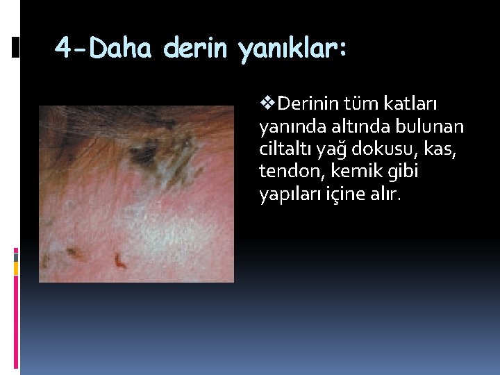 4 -Daha derin yanıklar: v. Derinin tüm katları yanında altında bulunan ciltaltı yağ dokusu, 4 -Daha derin yanıklar: v. Derinin tüm katları yanında altında bulunan ciltaltı yağ dokusu,