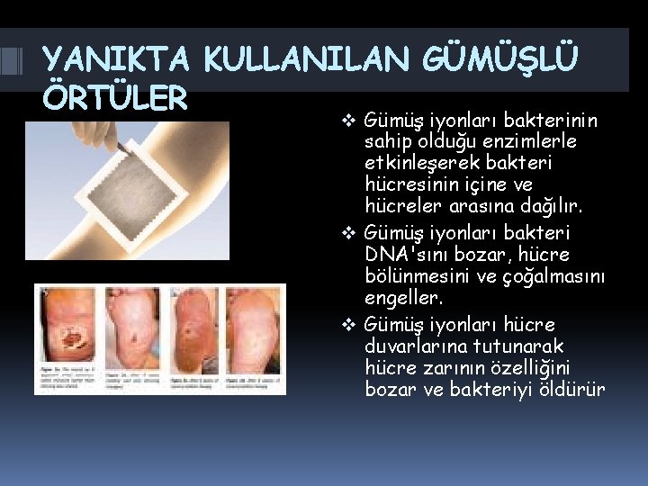 YANIKTA KULLANILAN GÜMÜŞLÜ ÖRTÜLER v Gümüş iyonları bakterinin sahip olduğu enzimlerle etkinleşerek bakteri hücresinin YANIKTA KULLANILAN GÜMÜŞLÜ ÖRTÜLER v Gümüş iyonları bakterinin sahip olduğu enzimlerle etkinleşerek bakteri hücresinin