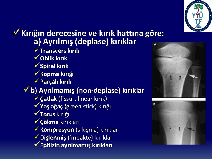 üKırığın derecesine ve kırık hattına göre: a) Ayrılmış (deplase) kırıklar üTransvers kırık üOblik kırık