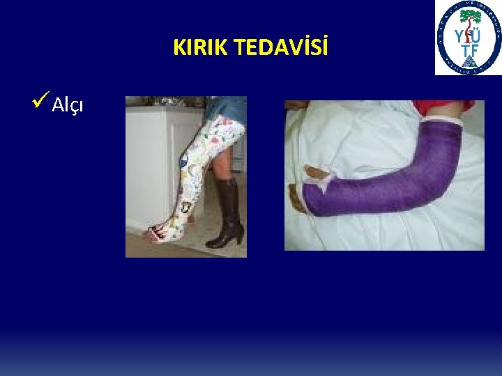 KIRIK TEDAVİSİ üAlçı 