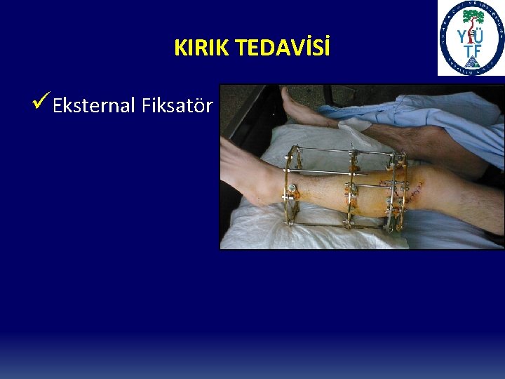 KIRIK TEDAVİSİ üEksternal Fiksatör 