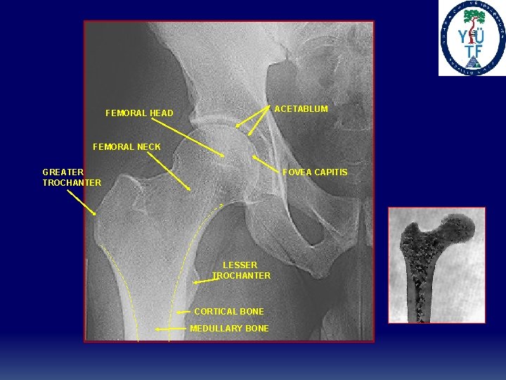 ACETABLUM FEMORAL HEAD FEMORAL NECK GREATER TROCHANTER FOVEA CAPITIS LESSER TROCHANTER CORTICAL BONE MEDULLARY