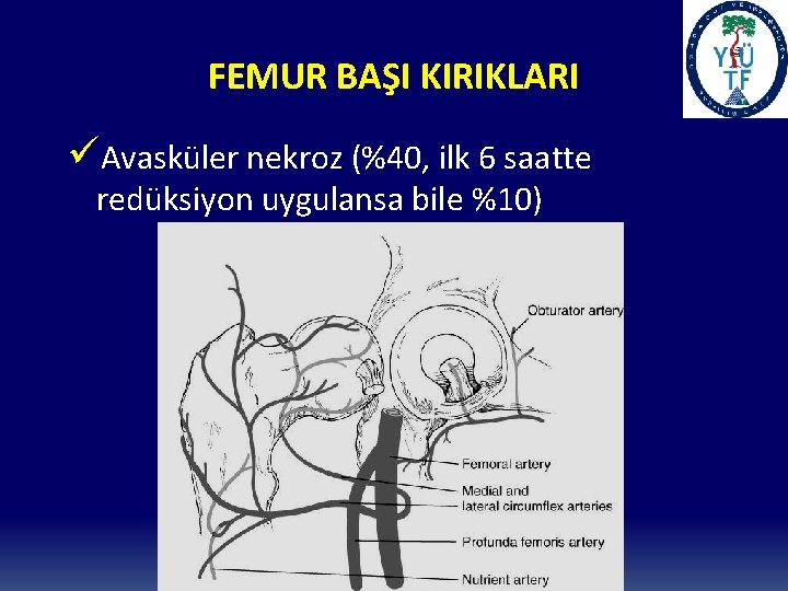 FEMUR BAŞI KIRIKLARI üAvasküler nekroz (%40, ilk 6 saatte redüksiyon uygulansa bile %10) 