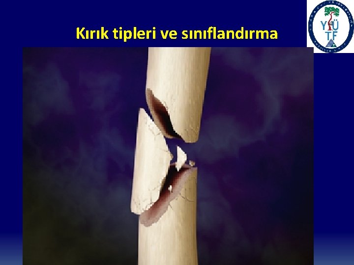 Kırık tipleri ve sınıflandırma 