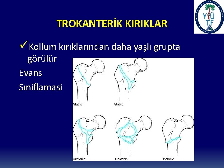 TROKANTERİK KIRIKLAR üKollum kırıklarından daha yaşlı grupta görülür Evans Sıniflamasi 