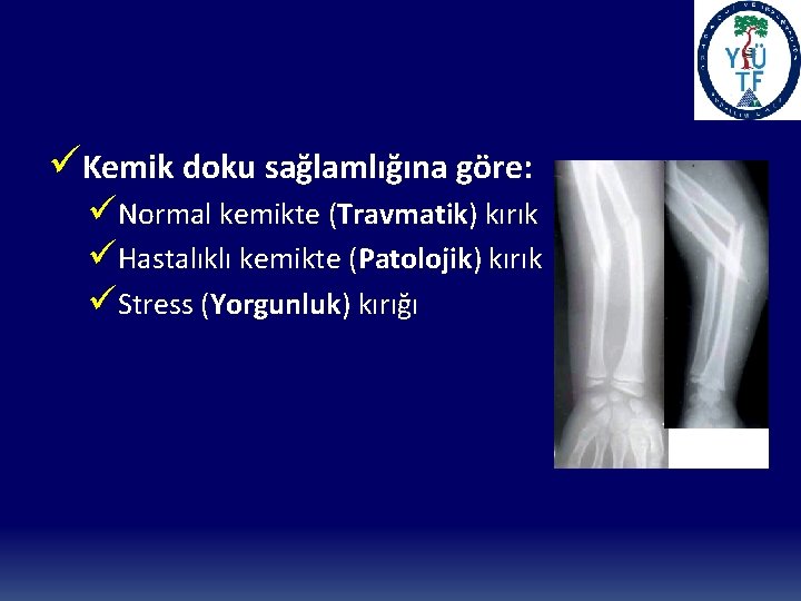 üKemik doku sağlamlığına göre: üNormal kemikte (Travmatik) kırık üHastalıklı kemikte (Patolojik) kırık üStress (Yorgunluk)