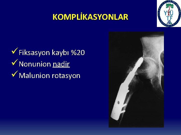 KOMPLİKASYONLAR üFiksasyon kaybı %20 üNonunion nadir üMalunion rotasyon 